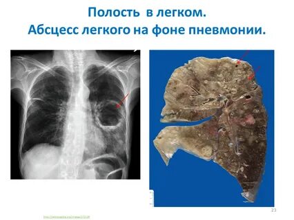 Полость в легком