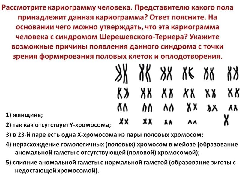 Какой метод определения числа хромосом в кариотипе. Кариограмма хромосом. кариограмма женщины. кариограмма шерешевского тернера. кариограмма синдрома шерешевского тернера.
