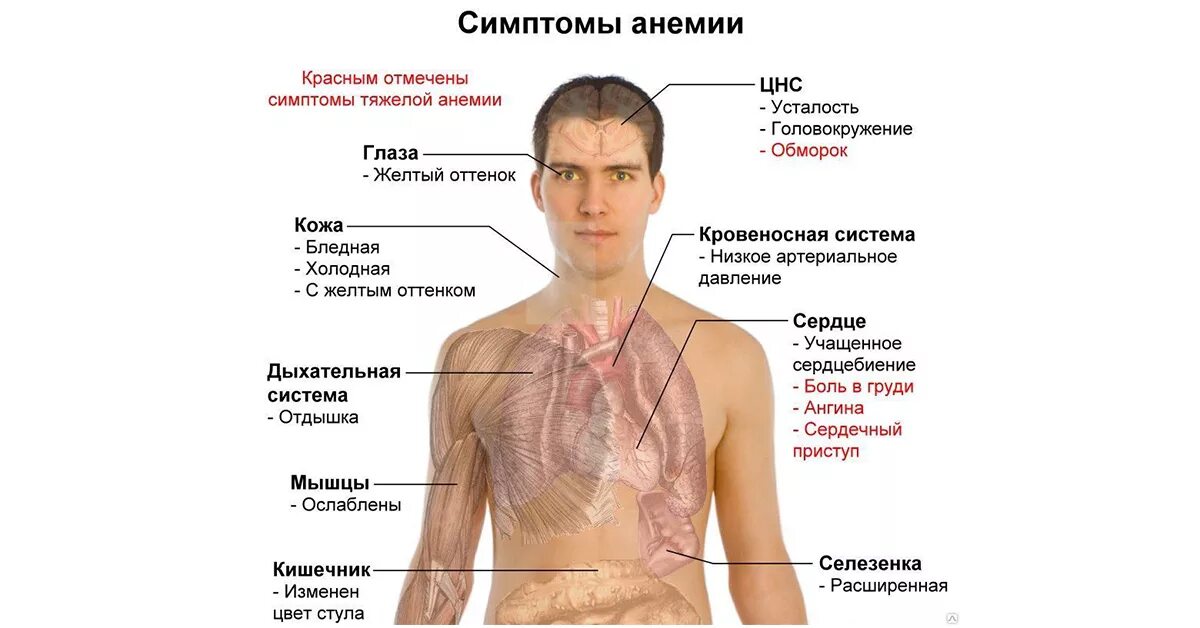 1 симптомы анемии. Тяжелая железодефицитная анемия симптомы. злокачественная анемия. злокачесвтенное малокроаие. основные признаки анемии.