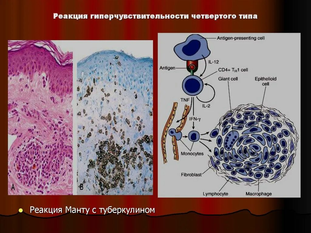 Иммунная гиперчувствительность. Реакция гиперчувствительности 4 типа. 4 Типа иммунопатологических реакций. Реакция гиперчувствительности IV типа: туберкулиновая реакция. 4 Тип гиперчувствительности.