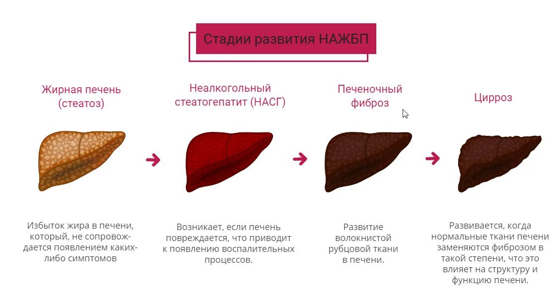 Признаки стеатоза печени. Неалкогольная жировая болезнь печени стадии. Классификация жирового гепатоза печени. Неалкогольный жировой гепатоз печени. Стадии жирового гепатоза печени.