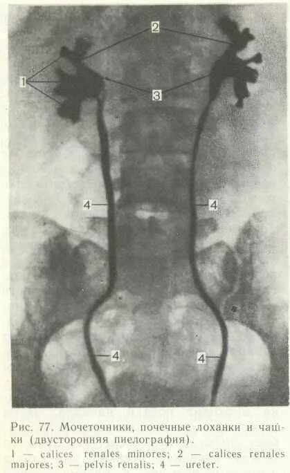 Как проходит мочеточник. Перешеек мочеточника. Почки и мочеточники расположение. Камень устья правого мочеточника.