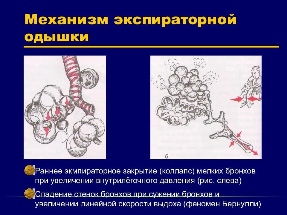 Спадение бронха