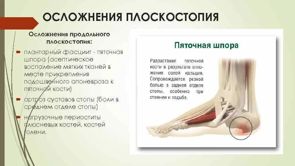 Состав пяток. Плантарный фасциит и плоскостопие. Место прикрепления подошвенной фасции к пяточной кости. Плоскостопие ахиллова сухожилия. Пяточная шпора воспаление.