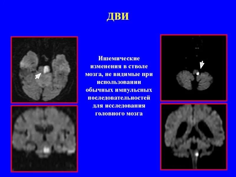 Ишемические изменения мозга. Мрт головного мозга Dwi. Ишемический инсульт ствола мозга. Инсульт мрт дви. Инсульт ишемический в стволе мрт.