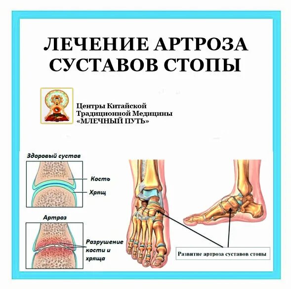 Эффективное лечение артроза сустава. Суставы стопы. Артроз в суставах среднего отдела стопы. Артроз суставной стопы это.