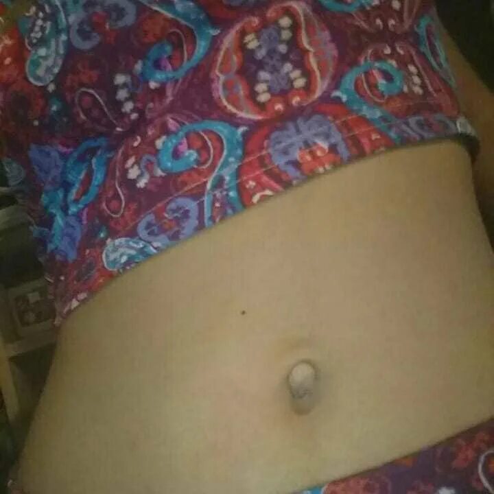 Наружу торчит. Наружу торчит. Автожесть. Примерно так выглядит. Пирсинг пупочной грыжи.