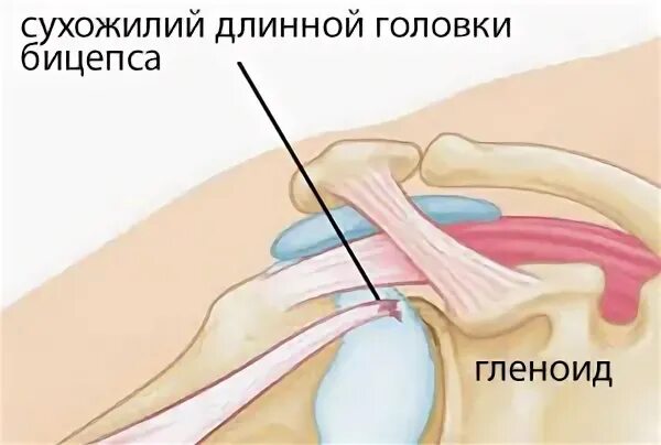 Синовит головки бицепса