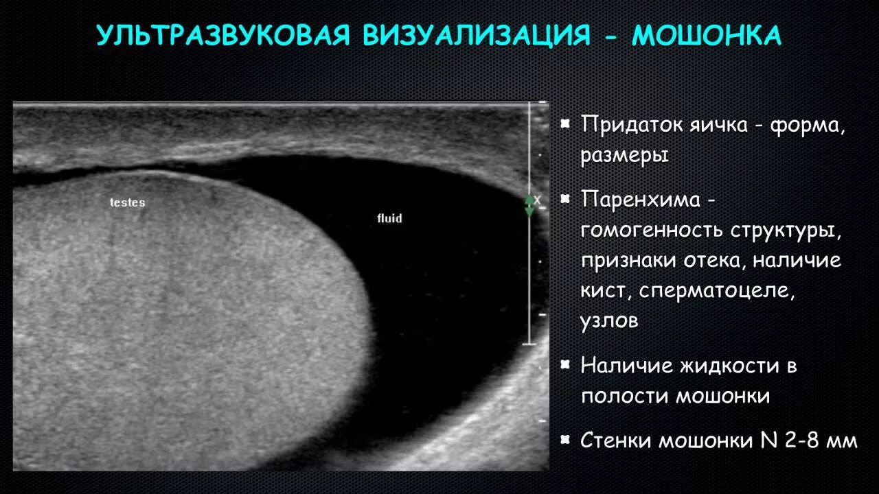 Киста семенного канатика на УЗИ протокол. Киста придатка яичка на УЗИ протокол. УЗИ мошонки норма протокол. УЗИ органов мошонки гидроцеле. Водянка яичек симптомы и лечение