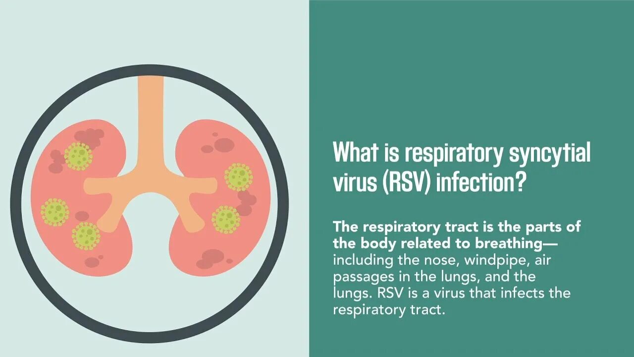 Syncytial virus. РСВ вирус. РС вирус. Respiratory syncytial virus Infectious disease. Respiratory syncytial virus diagnosis.