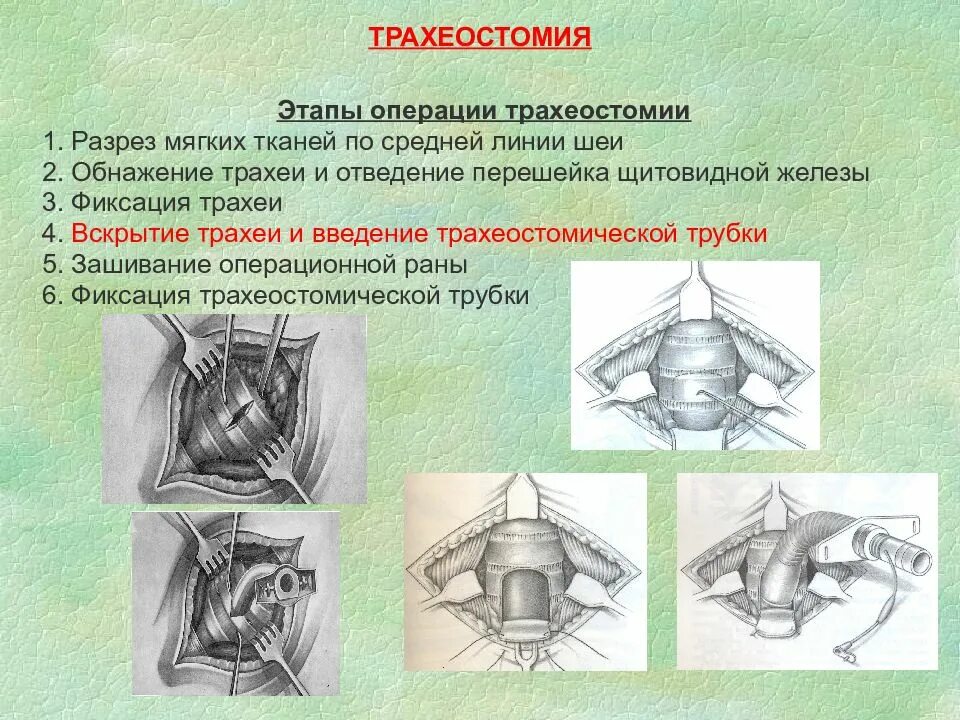 Алгоритм операции наложения. Трахеостомия топографическая анатомия этапы. Трахеостомия Оперативная хирургия техника. Трахеостомия топографическая анатомия этапы операц. Трахеостомия алгоритм хирургия.