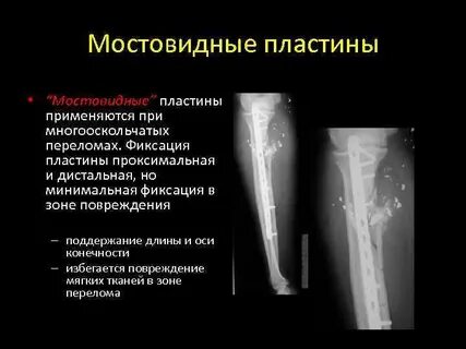 Перелом проксимального отдела большеберцовой кости