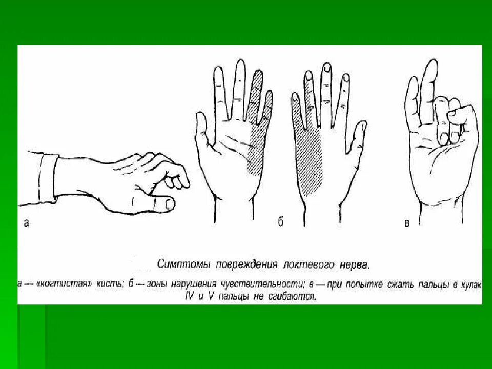 Повреждение локтевого нерва симптомы. Кисть при повреждении локтевого нерва. При поражении локтевого нерва.