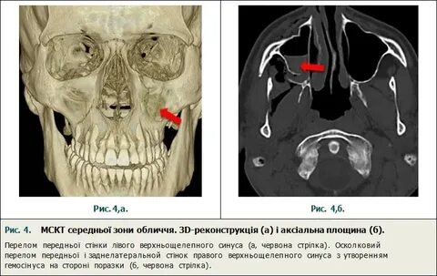 Ответы на тесты нмо перелом дна глазницы