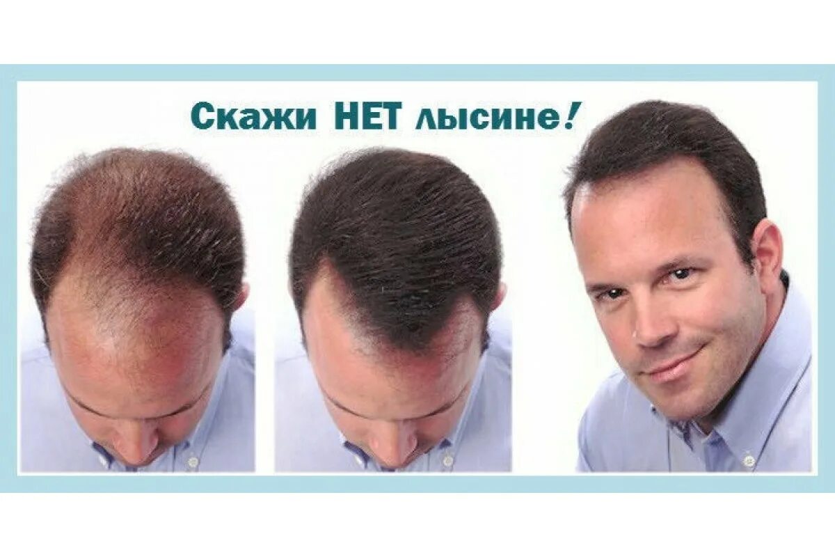 Как избавиться от залысин на голове. Лысина на макушке у мужчин стрижка. стрижки чтобы скрыть лысину. прически скрывающие залысины. мужские прически с залысинами.