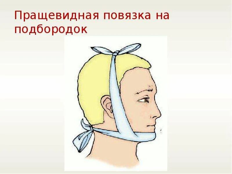 Техника наложения пращевидной повязки. Десмургия пращевидная повязка. Схема пращевидной повязки на подбородок. Наложение пращевидной повязки. Технику наложения пращевидной повязки на подбородок.