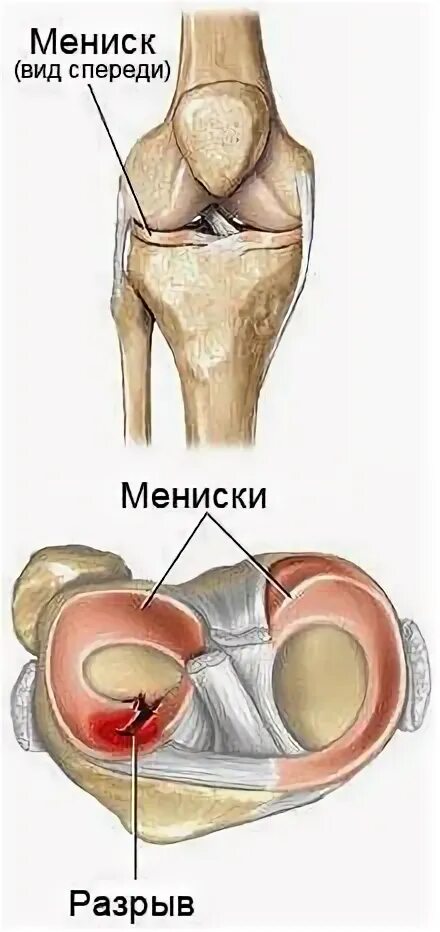 Повреждение мениска коленного сустава. Разрыв мениска коленного сустава. Повреждение мениска колена. Разрыв мениска коленного симптомы.