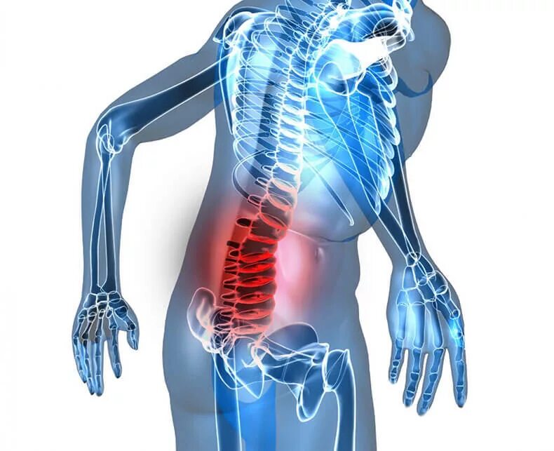 Радикулит поясница. Пояснично-крестцовый радикулит. Люмбаго. Опорно-двигательный аппарат человека. Дискогенный радикулит.