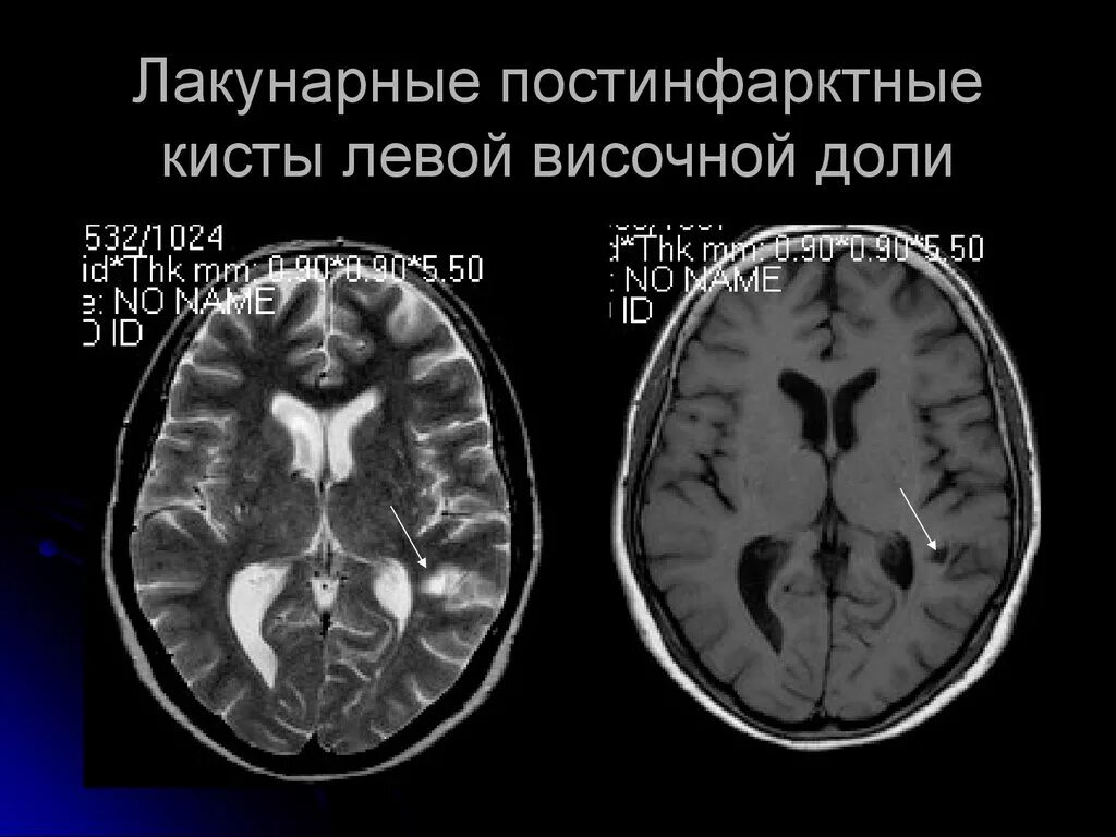 Киста головного мозга на кт. Киста левой височной доли. Постинфарктная киста головного мозга. Лакунарная киста головного мозга на кт. Постишемические кисты мозга