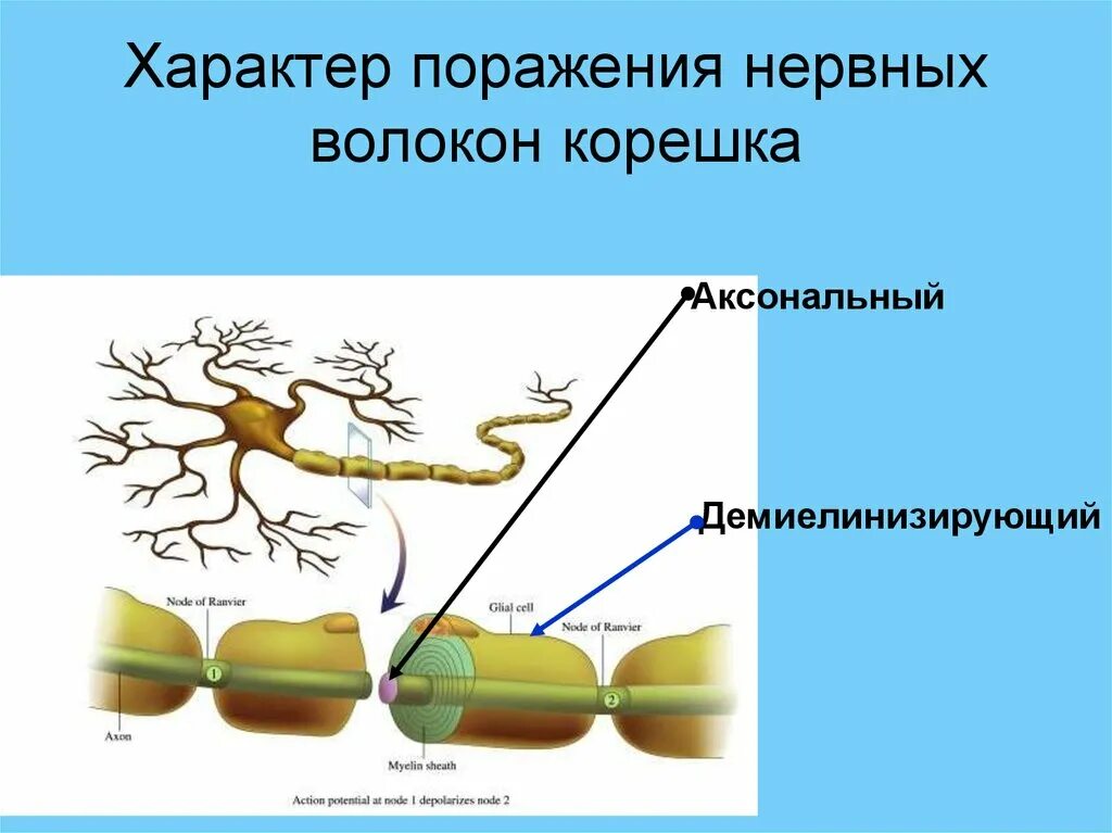 Аксональное поражение сенсорных нервов. Поражение нервных волокон. Аксональные и Демиелинизирующие полинейропатии. Аксональный Тип поражения. Аксональное и демиелинизирующее повреждение.