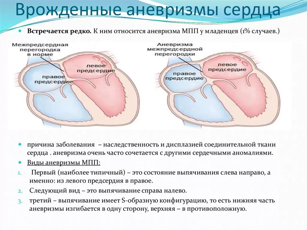 Аневризма сердца что это такое симптомы. Аневризма МПП сердца у ребенка. Аневризма МПП сердца типы. Межпредсердная перегородка в средней трети истончена.