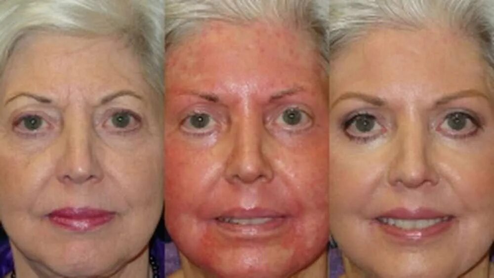 Пилинг джесснера осложнения. Разглаживает морщины. Лицо с морщинами до и после. Крем от морщин. Техника наппаж мезотерапия.