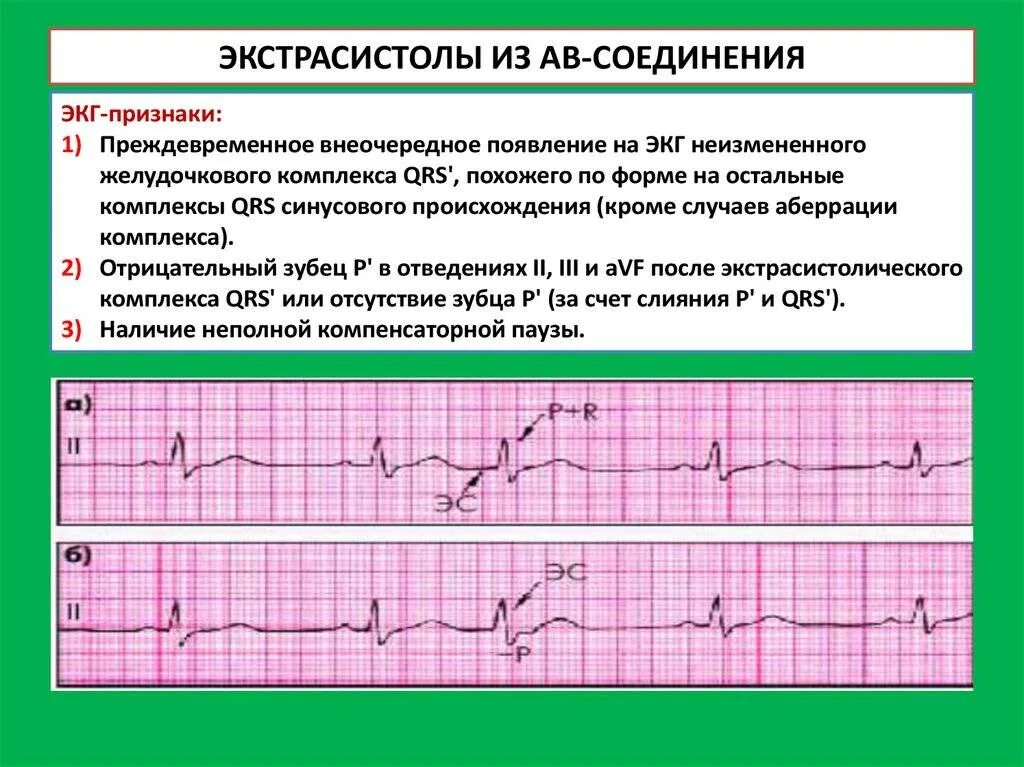 ЭКГ атриовентрикулярная экстрасистола. АВ Узловая экстрасистолия на ЭКГ. Наджелудочковая экстрасистола на ЭКГ. Атриовентрикулярная экстрасистолия на ЭКГ. Экстрасистолы много