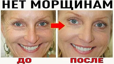 Колите ботокс