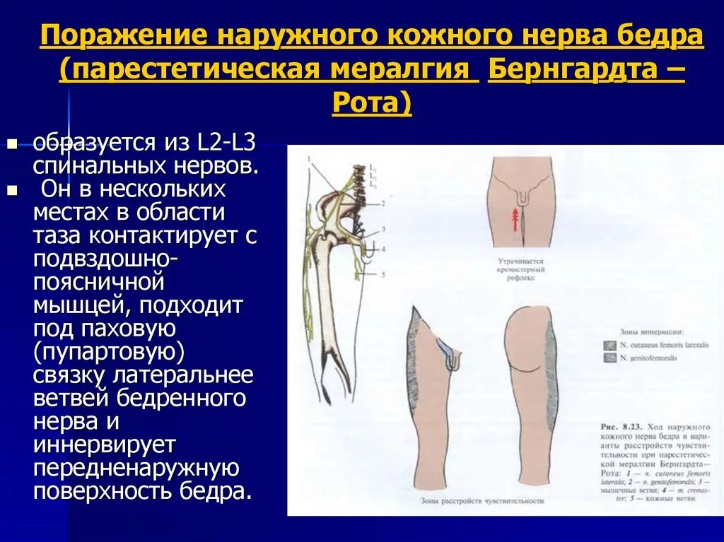 Поражение 3 нерва. Невропатия наружного кожного нерва бедра (болезнь рота).. Симптомы поражения бедренного нерва неврология. Нейропатия подкожного бедренного нерва. Невропатии бедренного нерва синдромы.