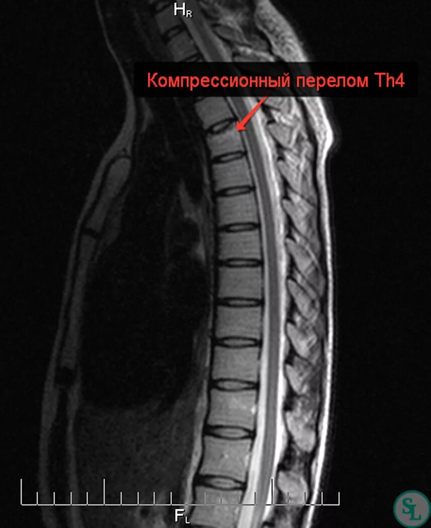 Ребенок сломал позвоночник. Компрессионный перелом th1. Компрессионный перелом th7 позвонка. Компрессионный перелом позвонка грудного отдела у ребенка. Компрессионный перелом грудного позвонка мрт.