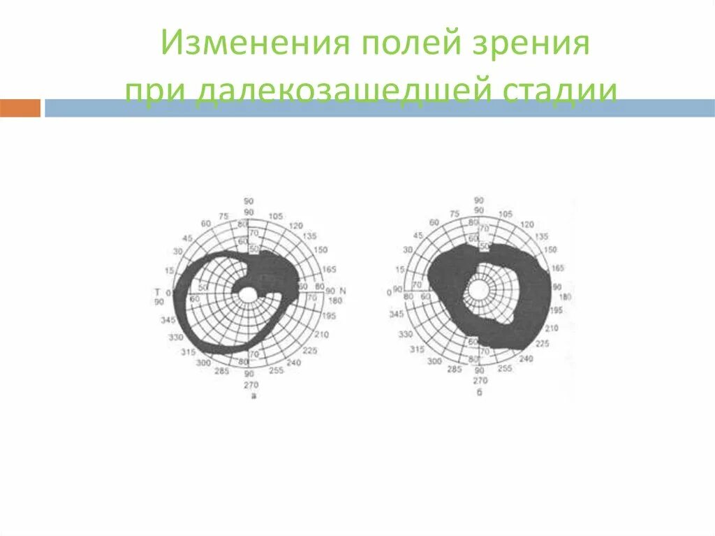 Центральное поле зрения. Сужение поля зрения периметрия глаукома. 3 Стадия глаукомы периметрия. Изменение полей зрения. Изменение полей зрения при глаукоме.