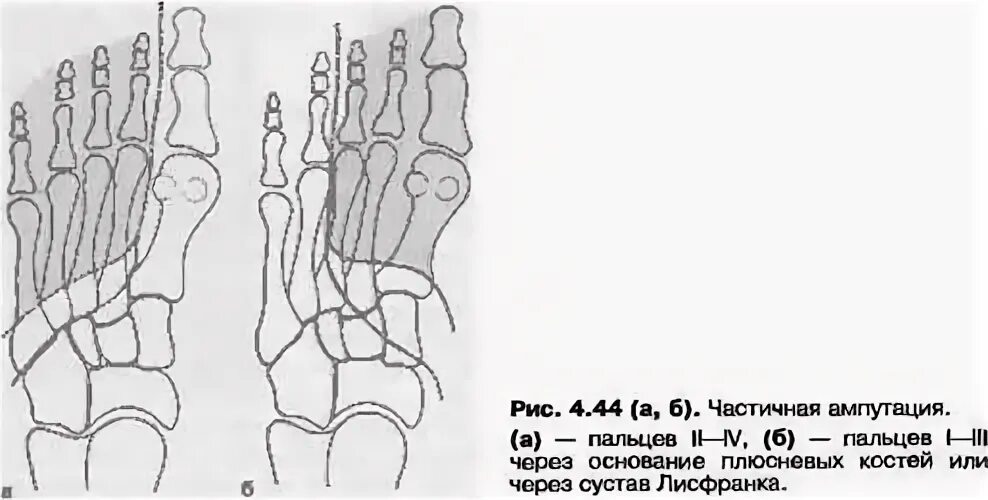 Резекция плюсневой кости. Ампутация плюсневой кости. Ампутация 3 пальца стопы. Ампутационная культя пальца на уровне.