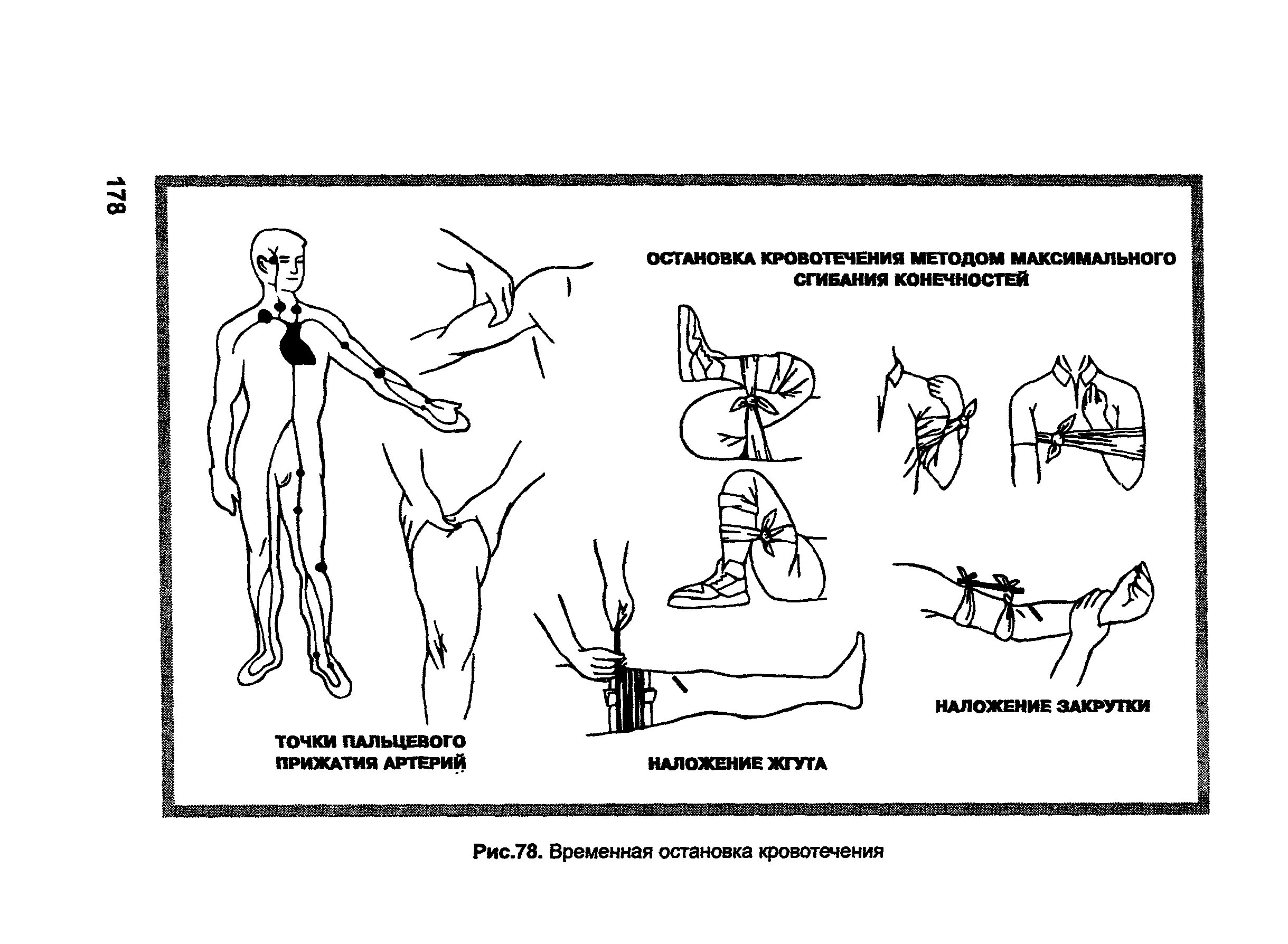 Пути остановки кровотечений. Методы остановки кровотечения схема. Кровотечение методы остановки кровотечения. Схема остановки артериального кровотечения. Алгоритм временной остановки наружного кровотечения.
