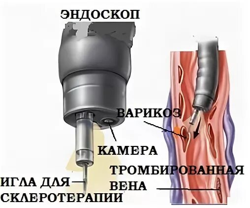 лигирование сосудов желудка и пищевода. легирование пищевода. лигирование врв пищевода. эндоскопическое лигирование пищевода. легирование вен пищевода что это.
