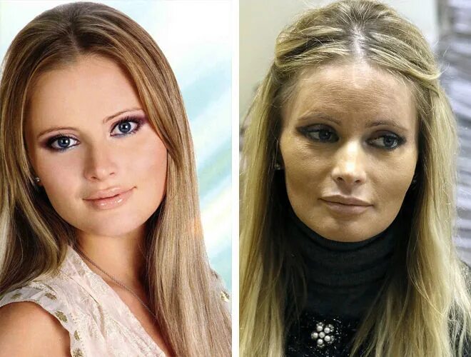 16-летняя дочь Даны Борисовой похудела на опасном для жизни "Оземпике" WOMAN