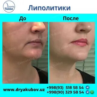 Липолитики для лица сколько процедур