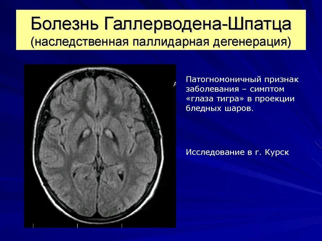 Дегенеративные изменения головного мозга