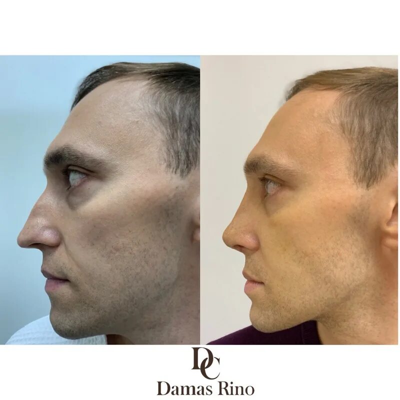Фото ринопластики до и после нос. Ринопластика до и после мужчины. Ринопластика носа мужчины до и после.