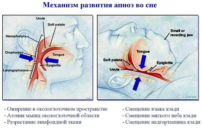 При засыпании останавливается дыхание. Остановка дыхания во сне. Апноэ. Механизм возникновения апноэ.