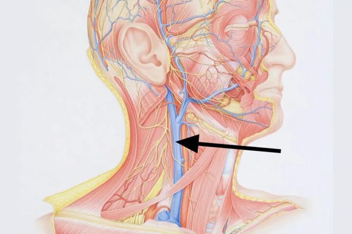 Сонная артерия и яремная Вена. Внутренняя Сонная артерия и внутренняя яремная Вена. Расширение яремной вены
