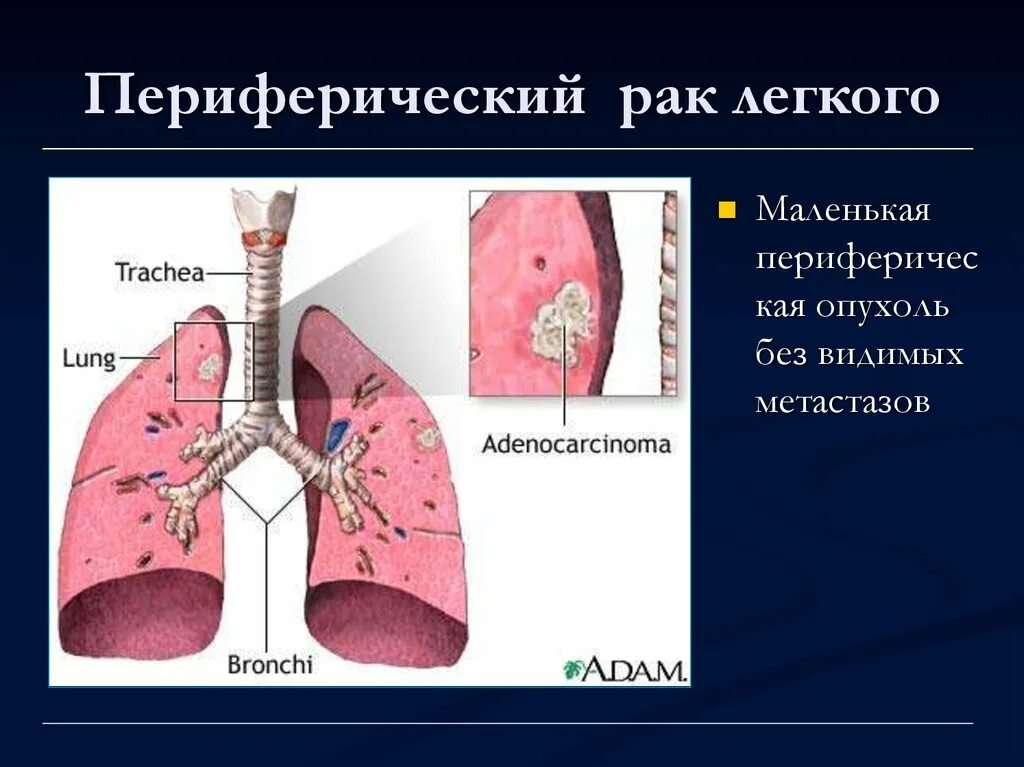 Стадии рака бронха. Периферические опухоли легких. Периферическая опухоль легкого. Центральная опухоль легкого.