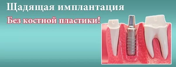 остеопластика костной ткани челюстей. имплантация без костной пластики. имплантация с расщеплением гребня. имплантация без костной пластики. имплантация без костной пластики.