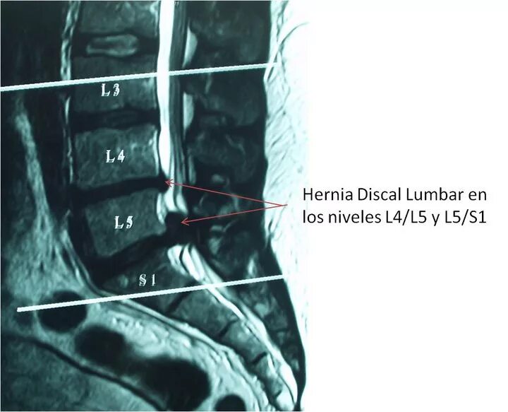 Включи l 3. Диск l4-s1. Позвоночная грыжа l1-l2. Диски l5-s1 в позвоночнике. L4 l5 s1 отдел позвоночника.