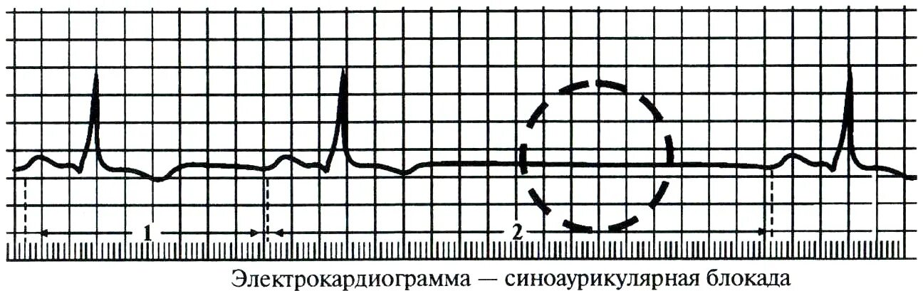 Синоаурикулярная блокада. Синоаурикулярная блокада Тип 1. Синоаурикулярная блокада на ЭКГ. ЭКГ аритмии и блокады. Синоаурикулярная блокада сердца на ЭКГ.