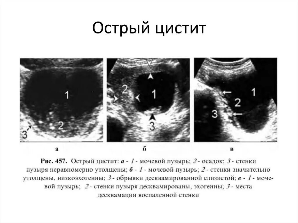 Узи брюшной полости полный мочевой пузырь. Острый цистит на УЗИ признаки. Острый цистит на УЗИ мочевого пузыря. УЗИ признаки хронического цистита. УЗИ картина мочевого пузыря при остром цистите.