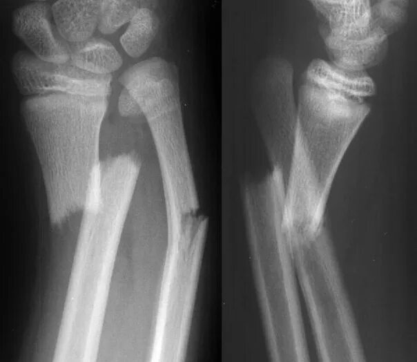 File:Colles fracture.JPG - Wikipedia