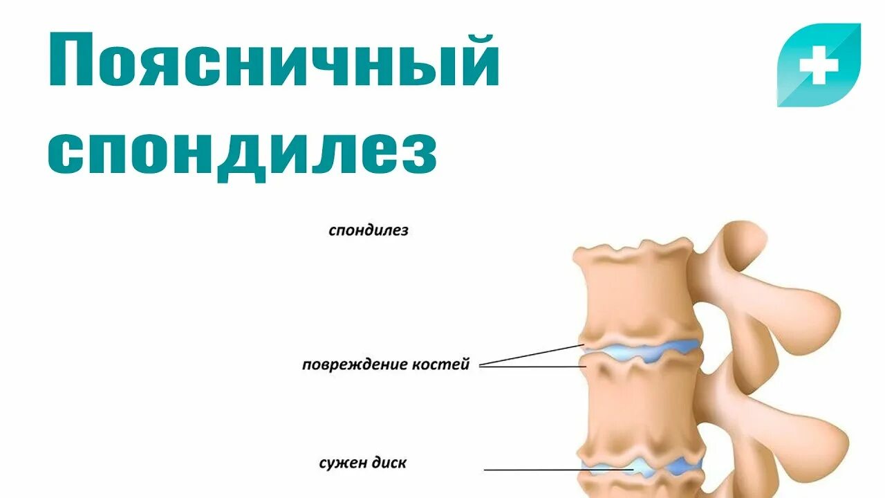 Спондилез отзывы