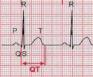 Происхождение интервала qt на экг связано с. Синдром удлиненного интервала qt. синдром удлиненного qt на экг. удлинение интервала qt на экг. интервал qt на экг.