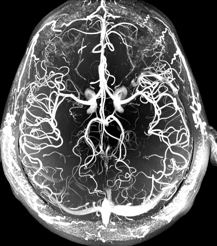 Мрт с контрастом головного. Магнитно-резонансная ангиография сосудов головного мозга. Мрт ангиография сосудов головного мозга. Кт ангиограмма сосудов головного мозга. Мрт венография сосудов головного мозга.