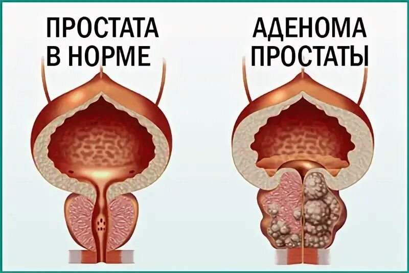 Помоги простате